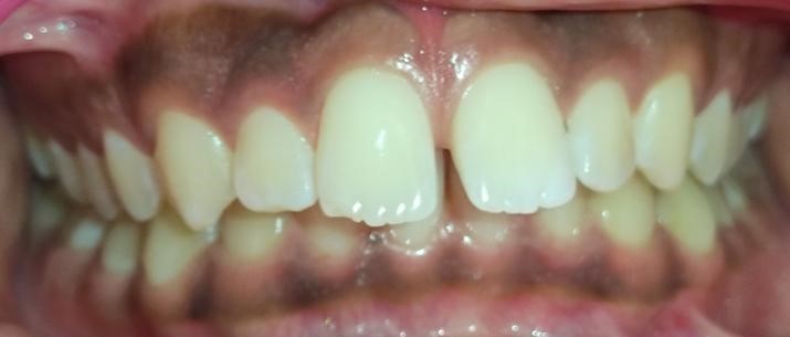 Deep bite upper front teeth corrected
