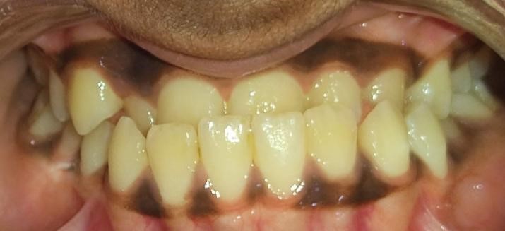 Reverse or cross bite upper front teeth corrented