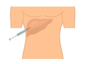 Liver Biopsy: Everything You Need to Know