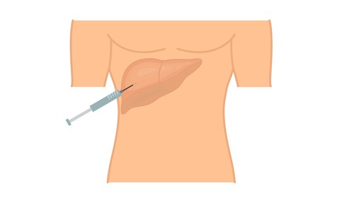 Liver Biopsy – Basics And More