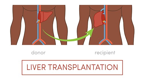Liver Transplantation – Frequently Asked Questions