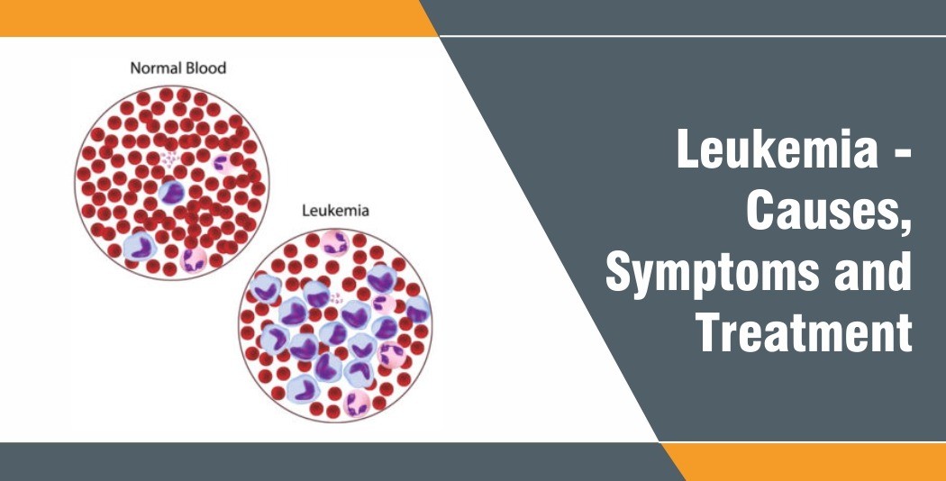 Blood Cancer – Causes, Symptoms and Treatment