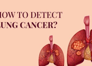 Lung Cancer: Symptoms, Risk Factors, Stages & Diagnosis