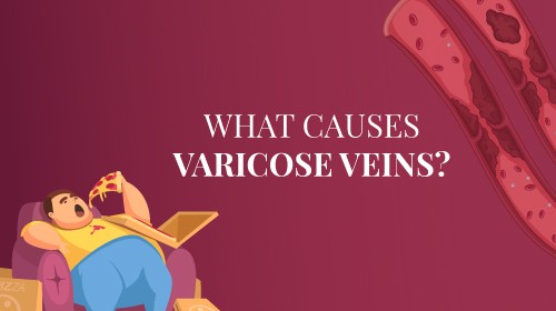 What Causes Varicose Veins?