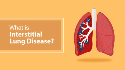 Interstitial Lung Disease: Symptoms, Causes, and Types