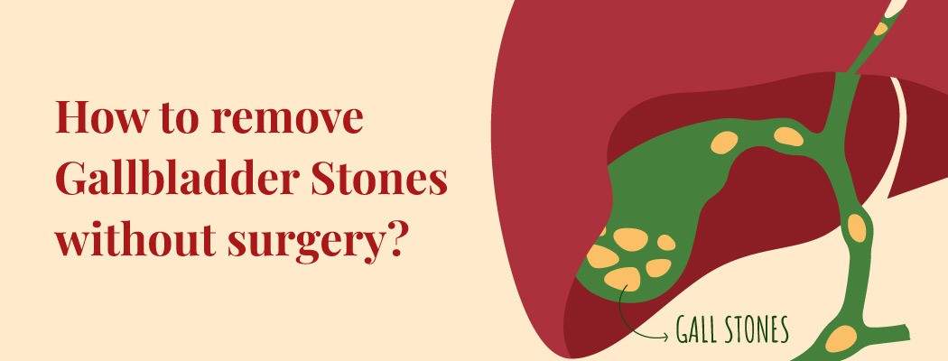 How to remove gallbladder stone without operation