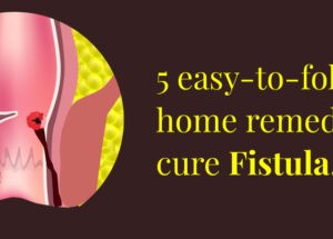 How to cure fistula permanently at home