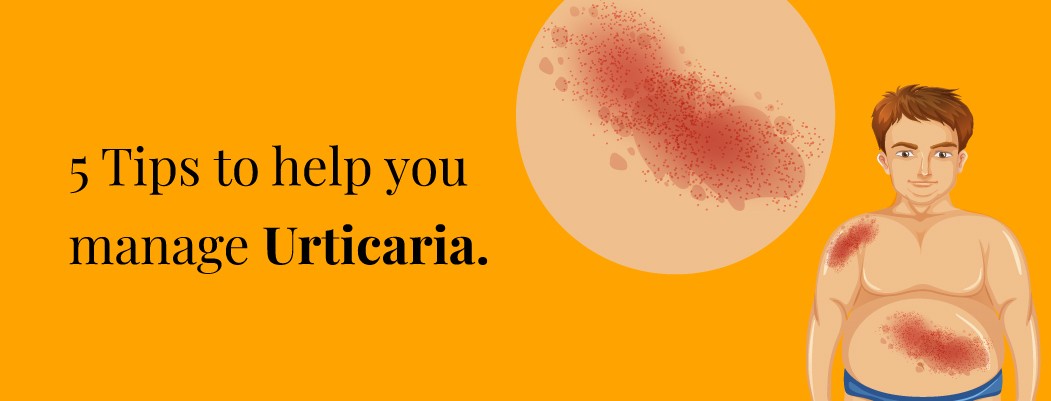 How to cure urticaria permanently