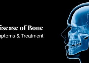What is Paget’s disease of the bone?