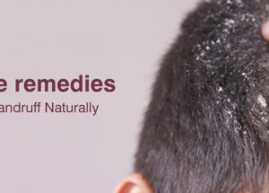 How to Get Rid of Dandruff and Hair Fall?
