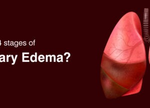 Pulmonary Edema Symptoms and Treatments