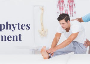 Osteophytes Treatment