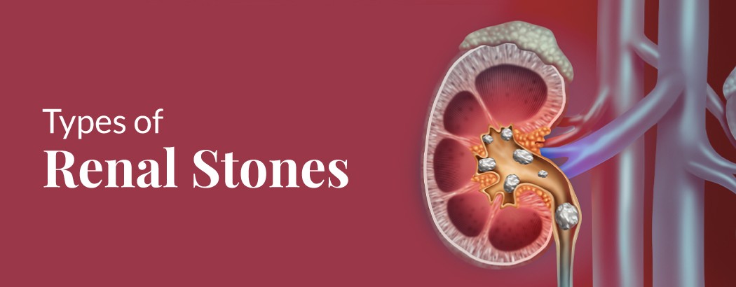 Types of Renal Stones