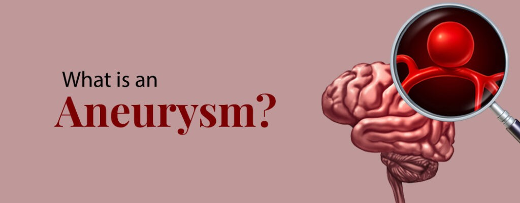 What is an aneurysm?