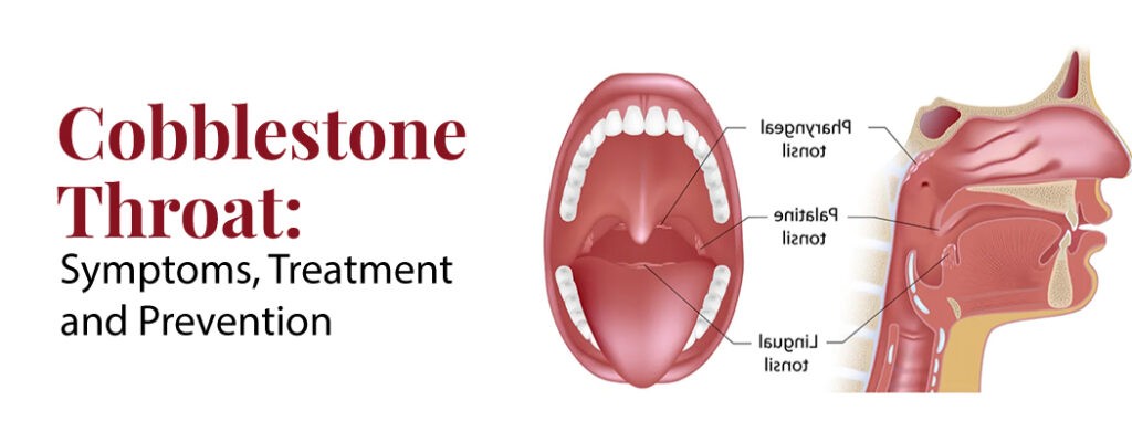 From Symptoms to Solutions: Exploring Cobblestone Throat Treatment and Prevention