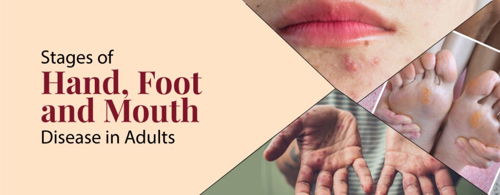 Stages of Hand, Foot and Mouth Disease in Adults.