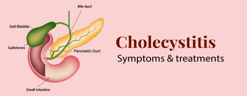 Cholecystitis: Symptoms and Treatment
