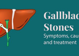 Gallbladder Stones: Symptoms, Causes and Treatment