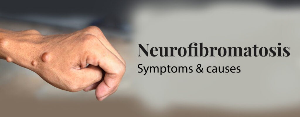 Neurofibromatosis: Symptoms, and Causes