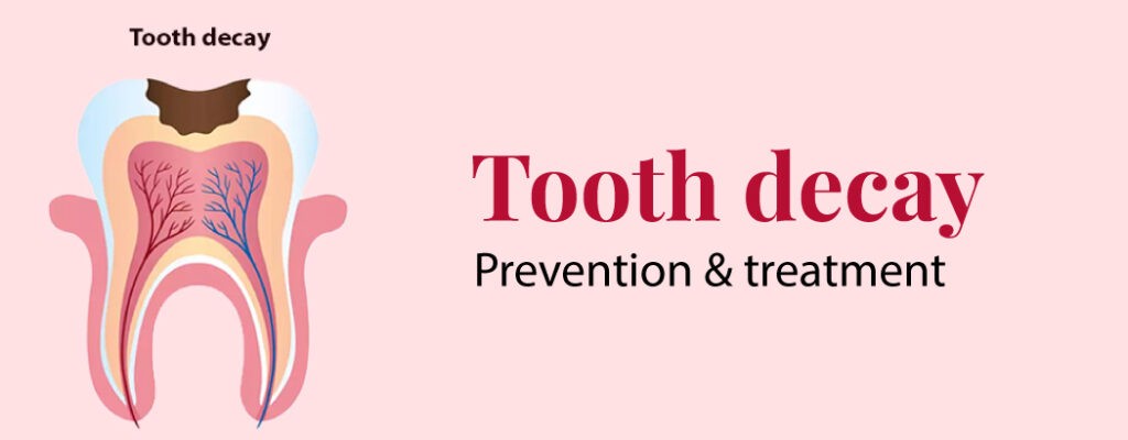 Tooth Decay: Prevention and Treatment