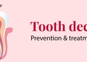 Tooth Decay: Prevention and Treatment
